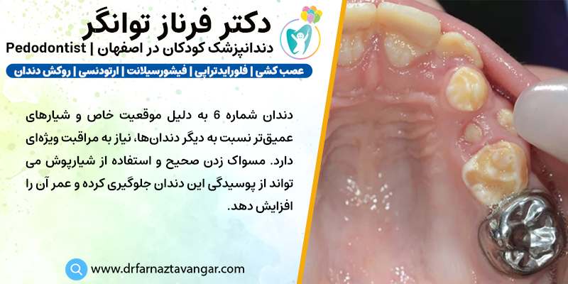 دندان شماره 6 چیست و چه اهمیتی دارد؟ - دکتر فرناز توانگر