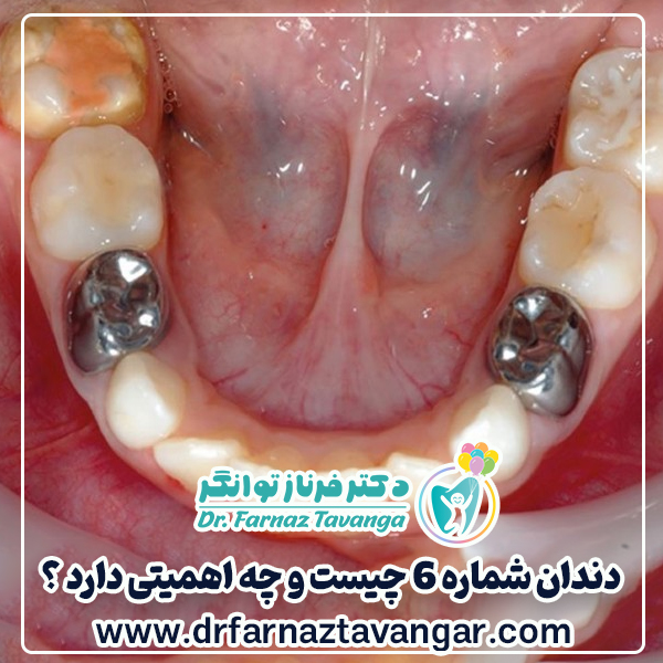 دندان شماره 6 چیست و چه اهمیتی دارد؟ - دکتر فرناز توانگر
